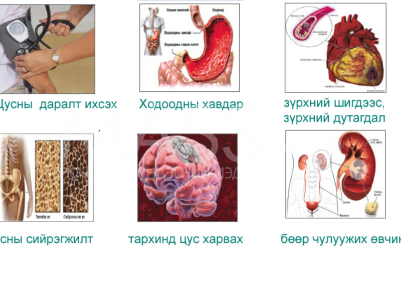 Давсыг хэтрүүлэн хэрэглэхийн хор уршиг